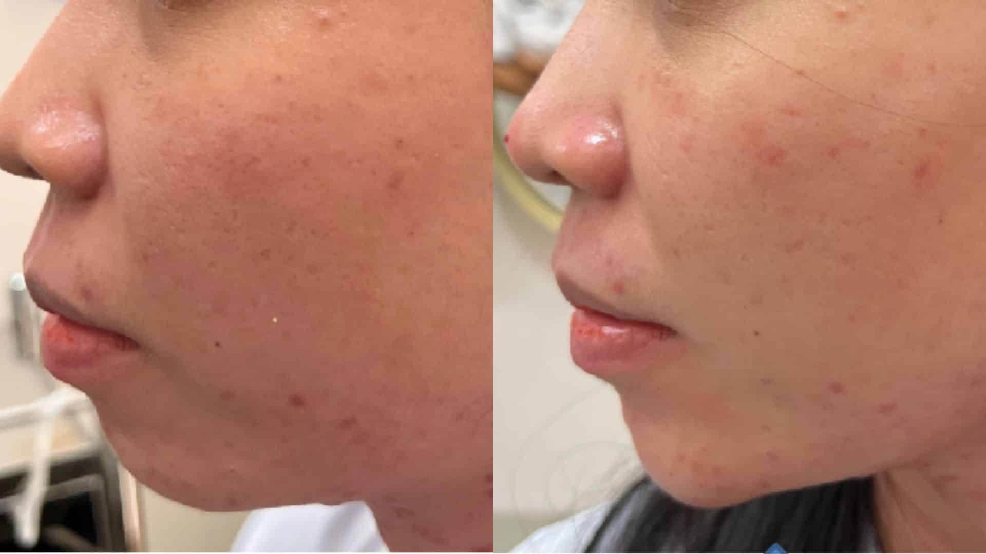 before after filler