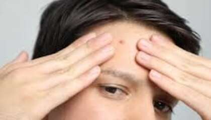 cara menghilangkan jerawat di jidat